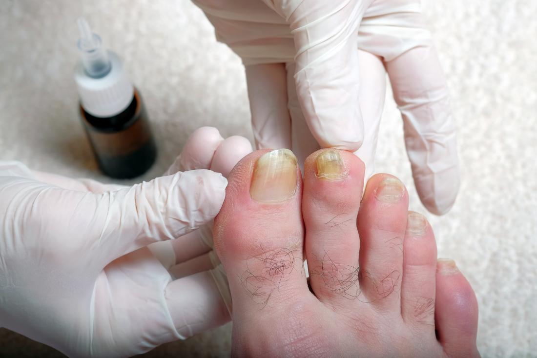 Thick Toenails: Pictures, Causes, and Home Treatments