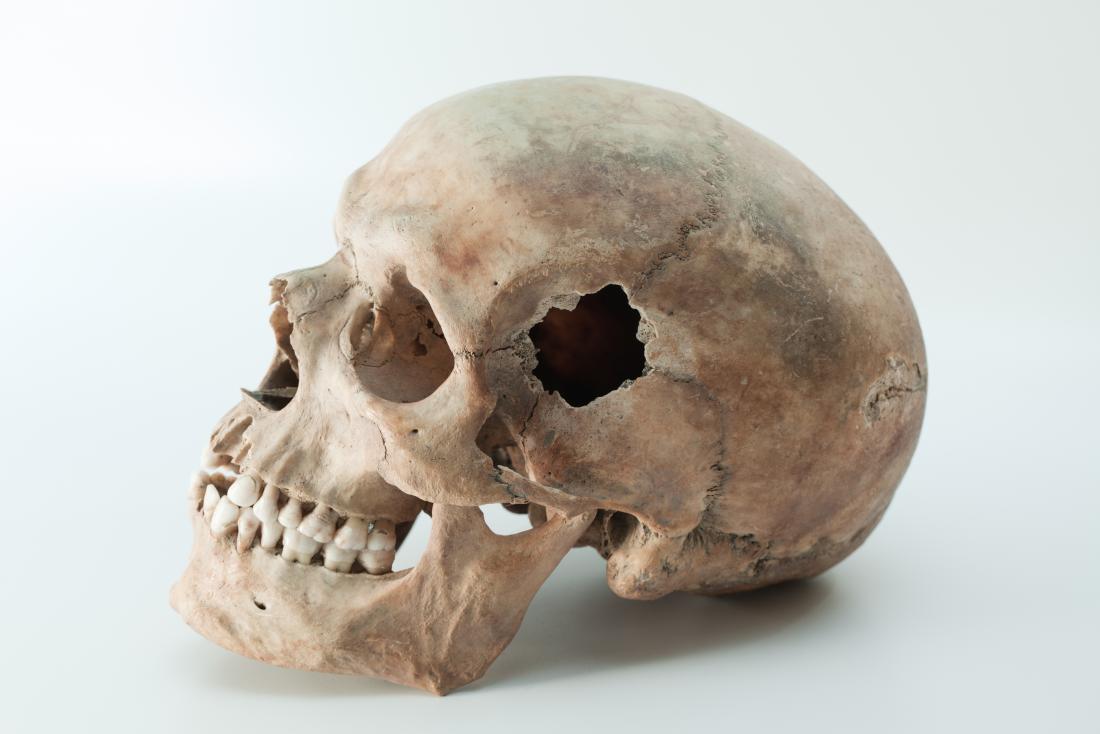 Skull-drilling: The ancient roots of modern neurosurgery