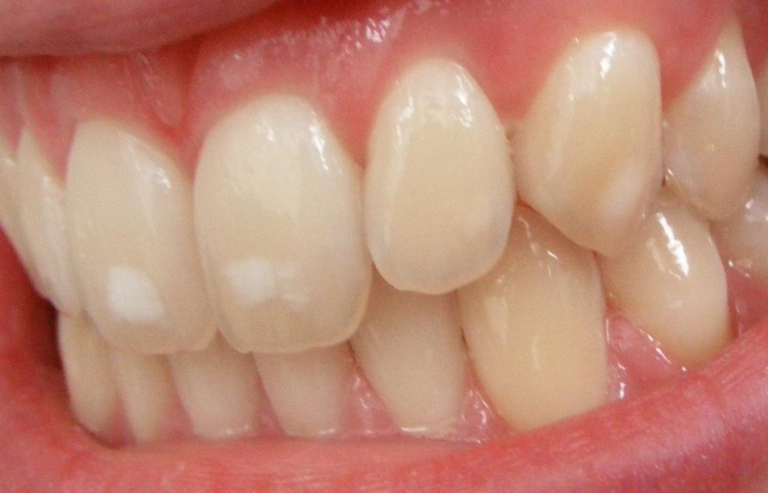 White Spots On Teeth 11 Tips On How To Get Rid Of Them - 