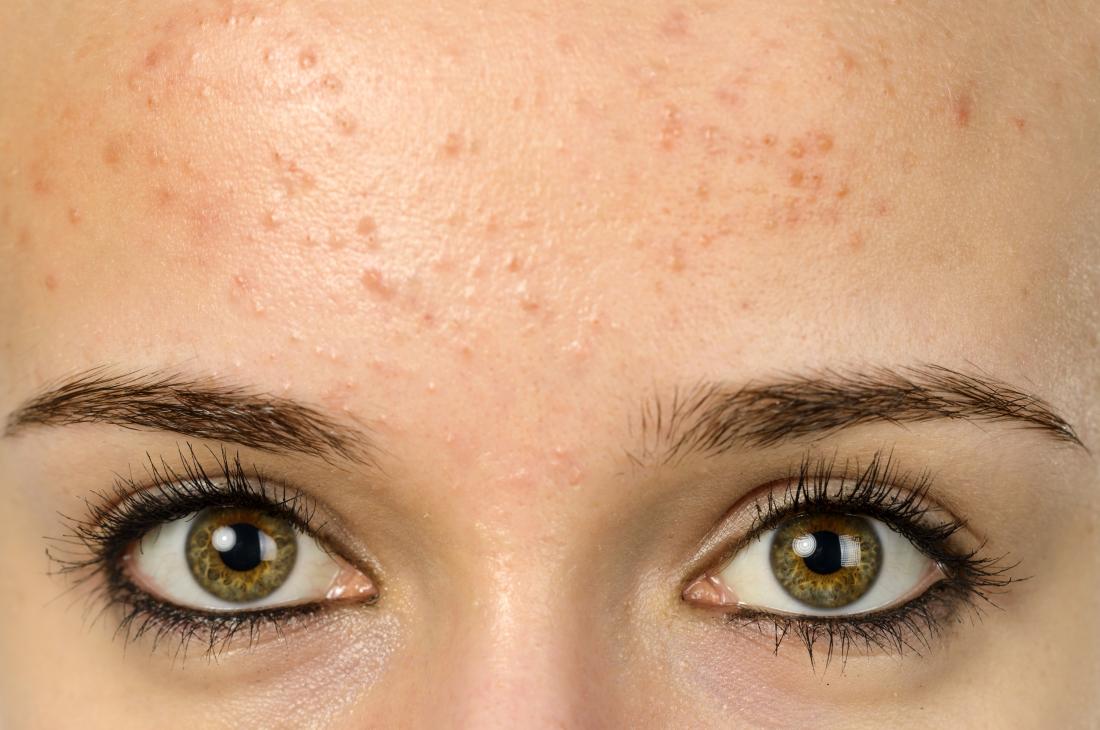 young woman with forehead acne