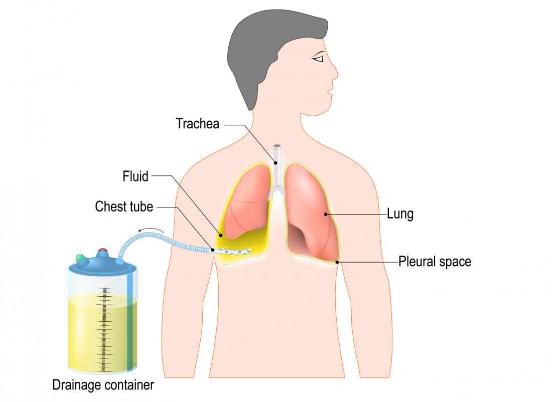 1180. Complications of chest tube placement (8) // Management of