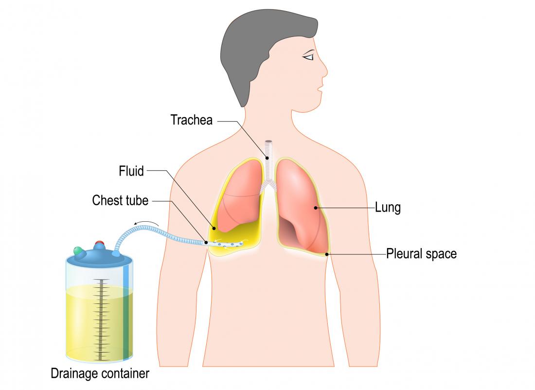 chest tube pneumothorax