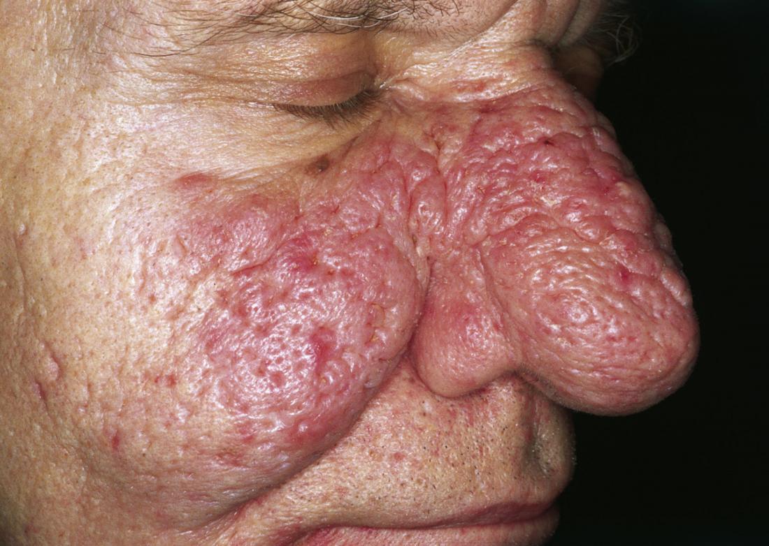 Rhinophyma <br>Image credit: M. Sand et al, Cutaneous lesions of the nose, 2010</br>