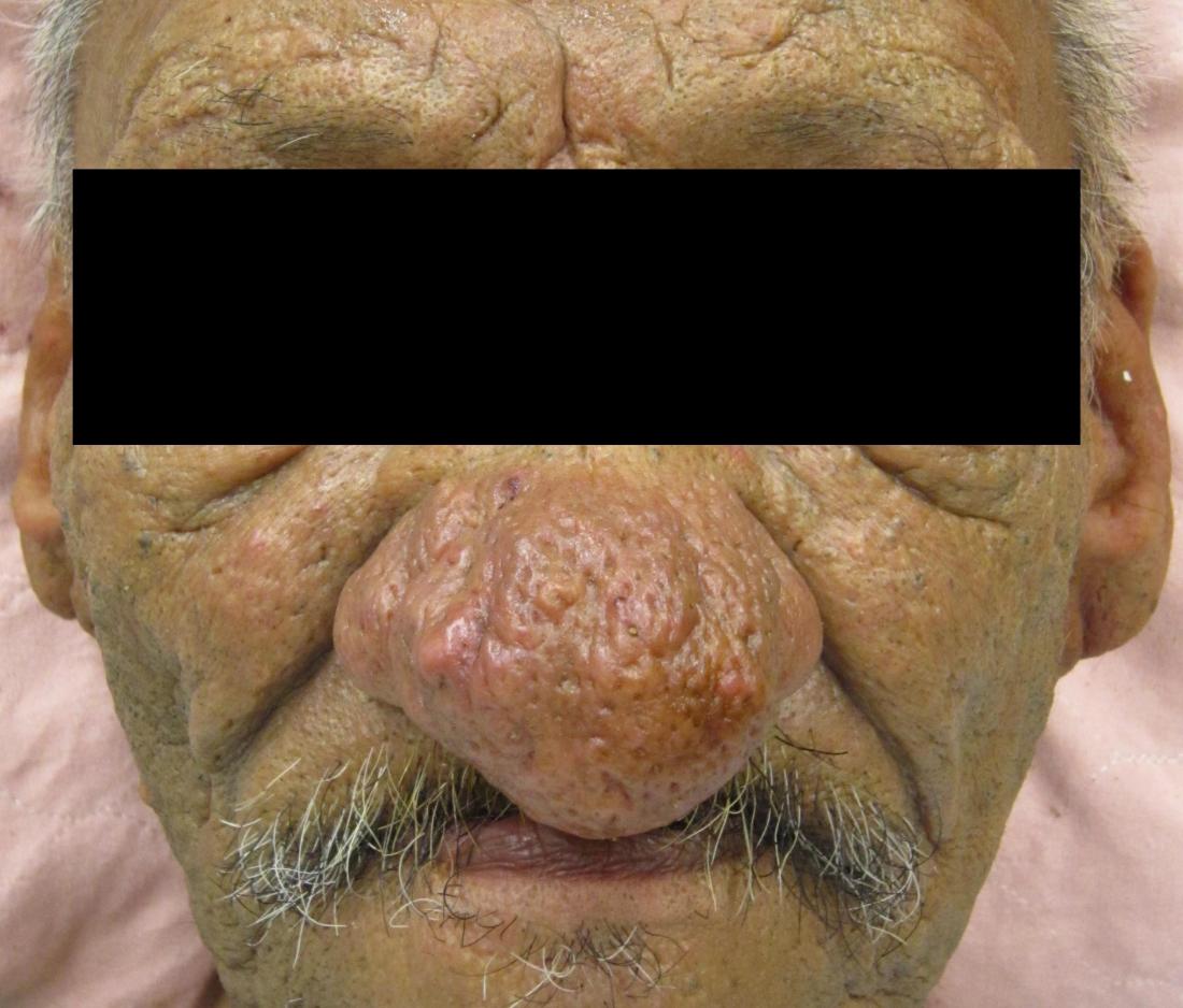 Rhinophyma of the nose <br>Image credit: James Heilman, MD, 2013</br>