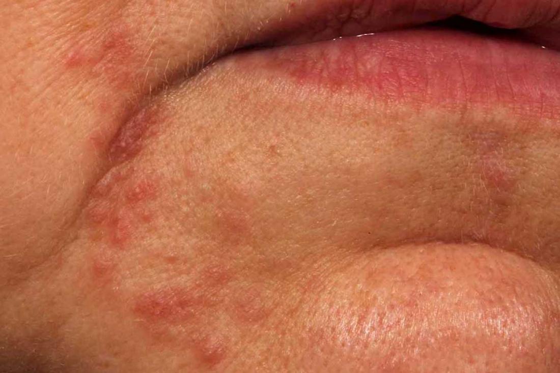 Perioral Dermatitis Symptoms Treatment And Pictures