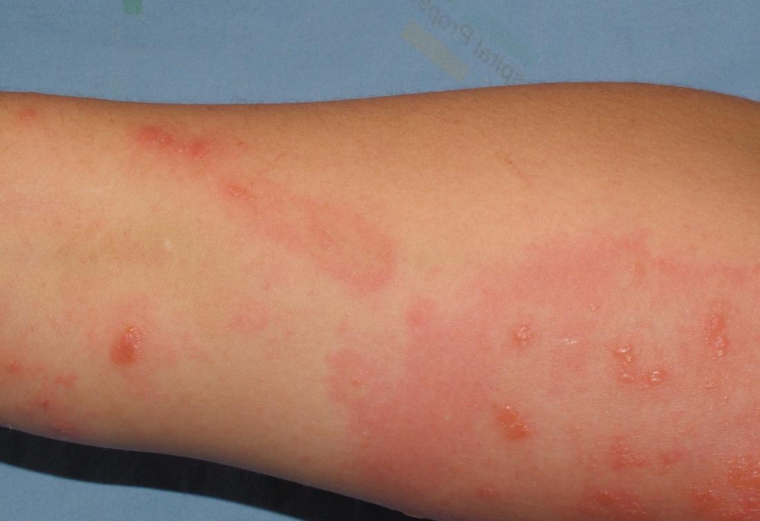 clindamycin skin rash