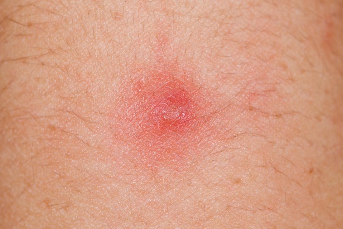 hpv-warts-skin-tags-private-parts-verycruise