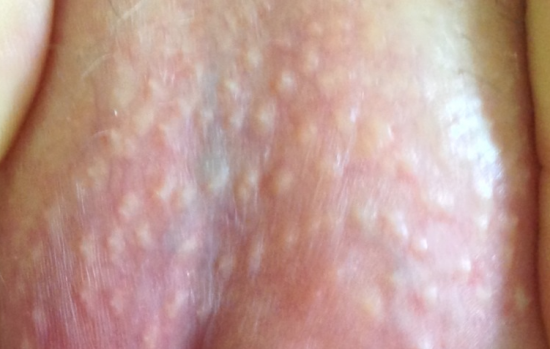 White hard pimple on scrotum