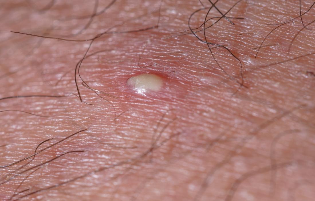 wart on scrotum skin)