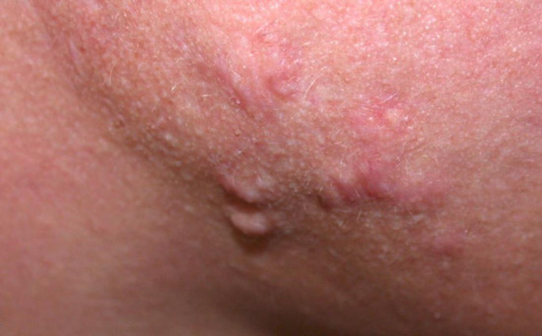 Nodules