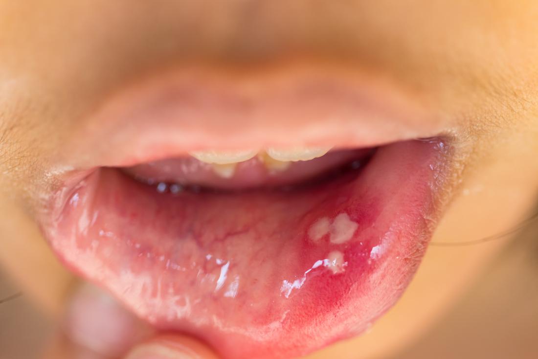 hpv wart in mouth