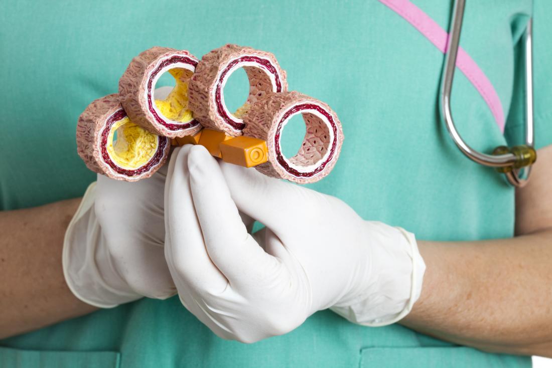 Atherosclerosis