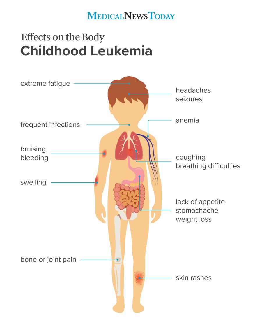 presentation of a child with acute lymphoblastic leukemia
