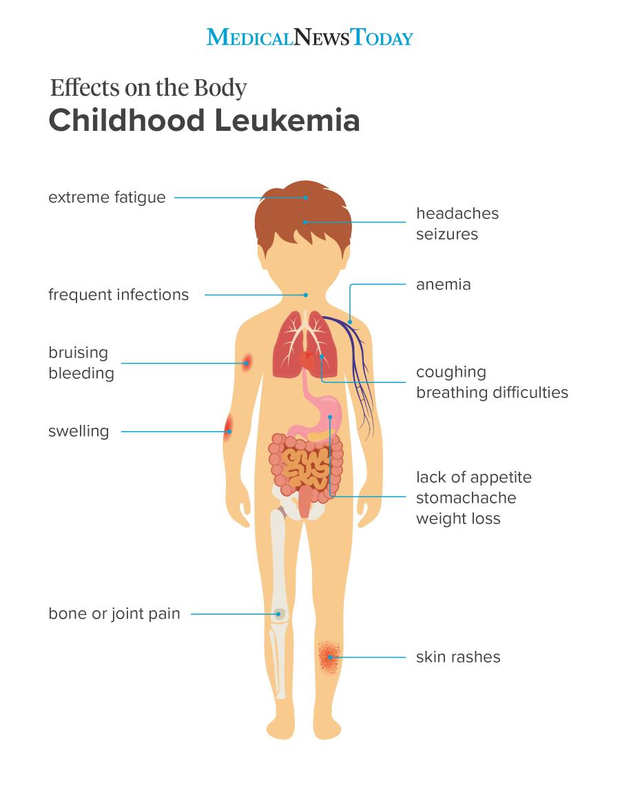 11 symptoms of leukemia in children