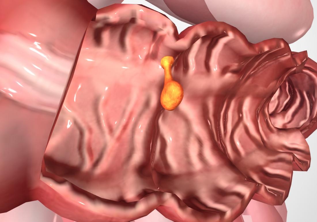 stages of colon polyps