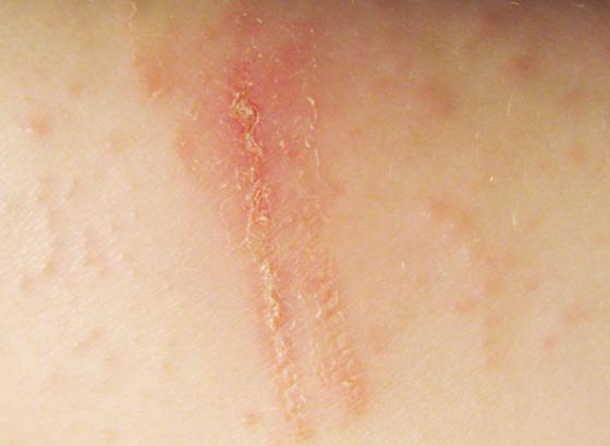 Contact dermatitis. Image credit: Digitalgadget, (2007, July 22).
