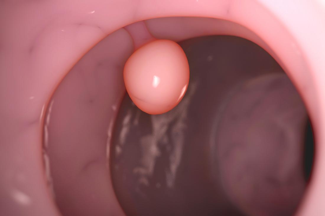 Vaginal epidermal cyst – Hysteroscopy Newsletter