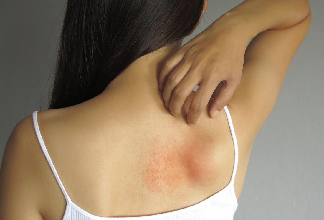 rashes on lower back