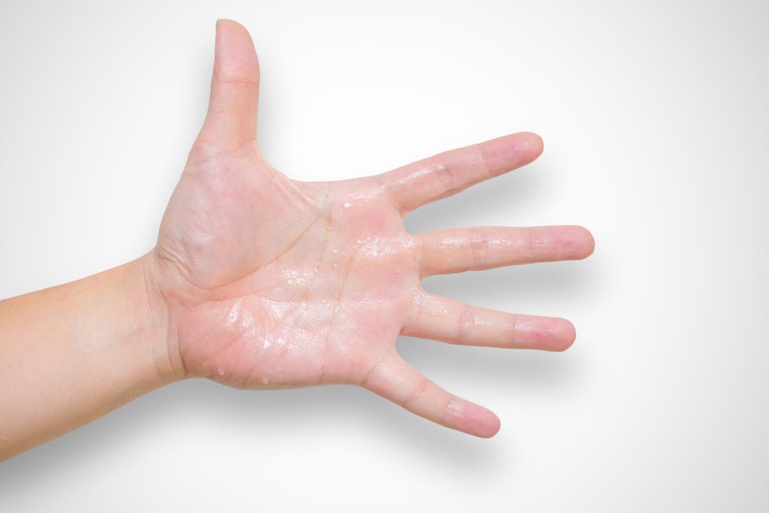 Treatment For Hyperhydrosis Of Hands