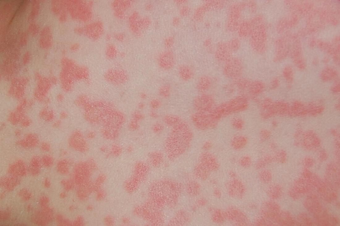 How can you tell if you have an amoxicillin rash?