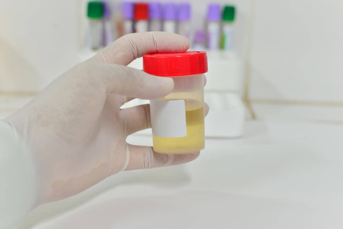 Testing a urine sample may help to diagnose ESKD.