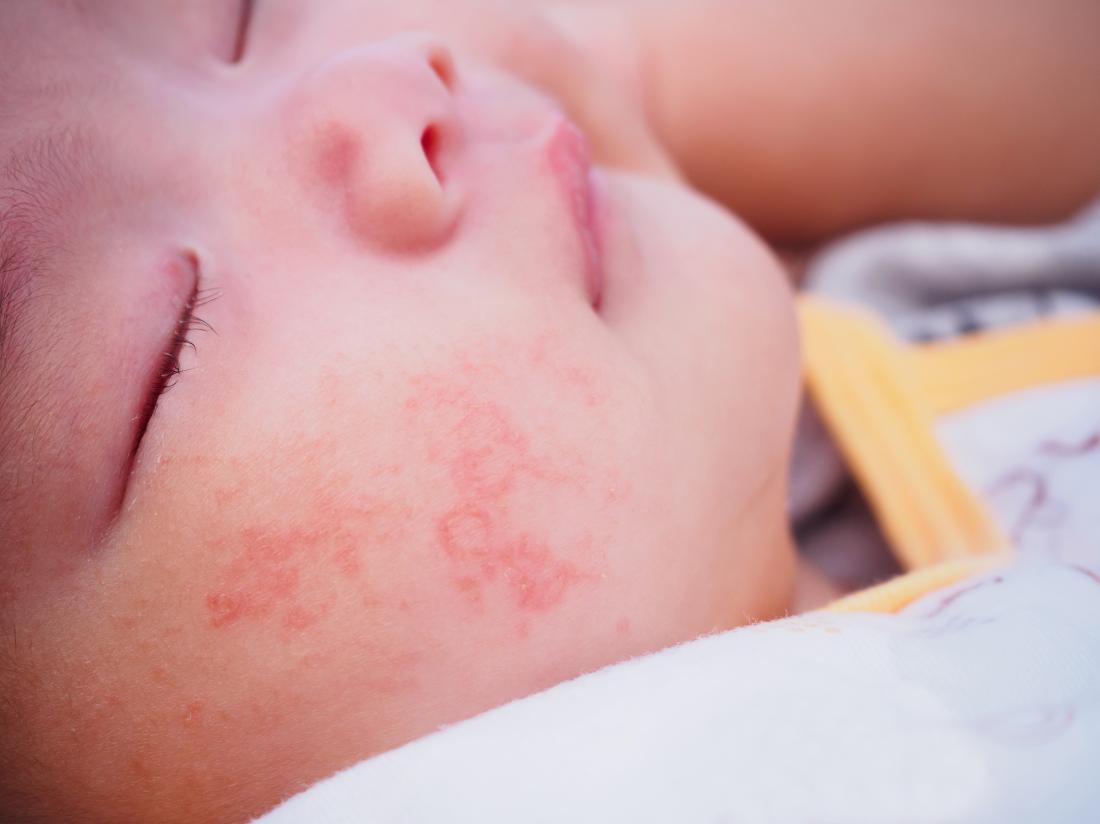 Allergic reaction in baby: Treatment and pictures