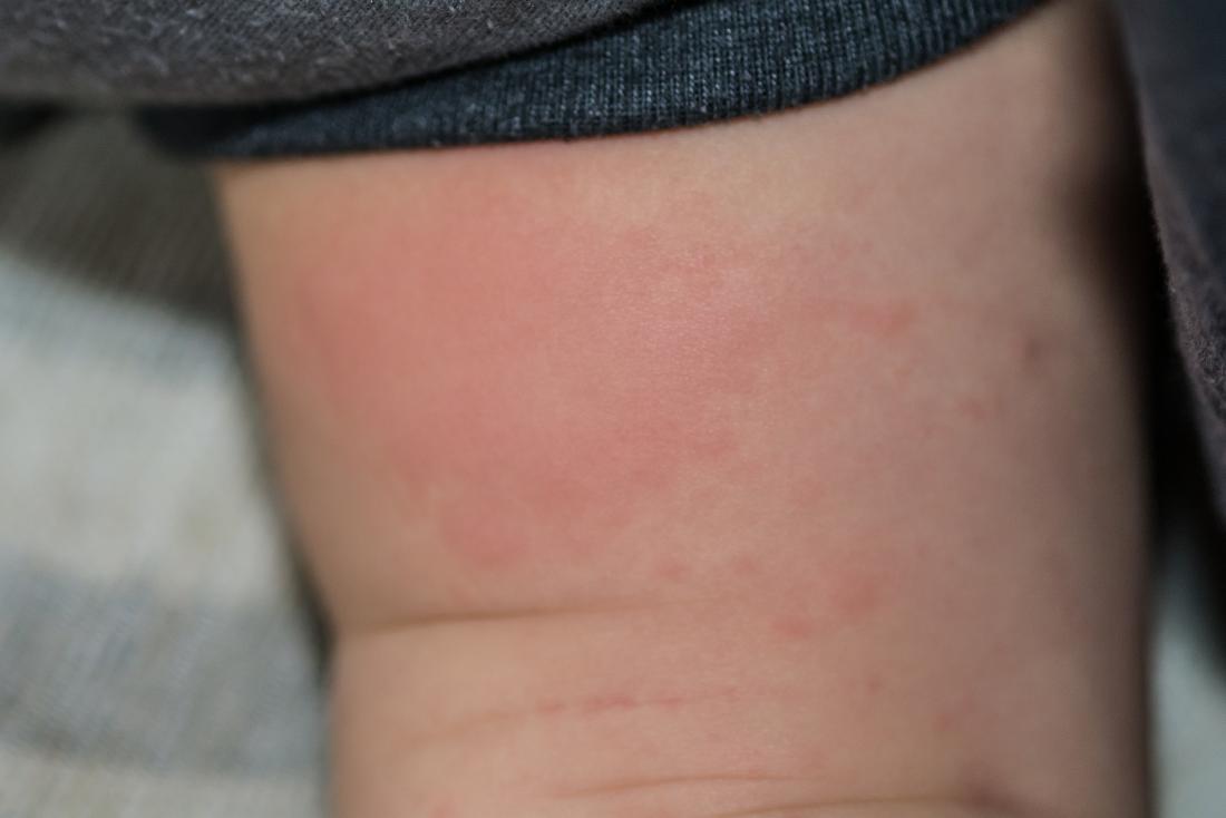 allergic reaction rash on babies