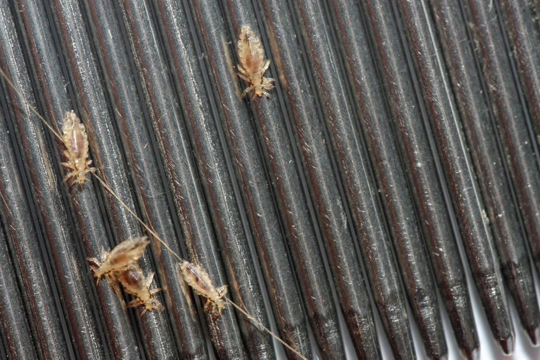 human hair head lice