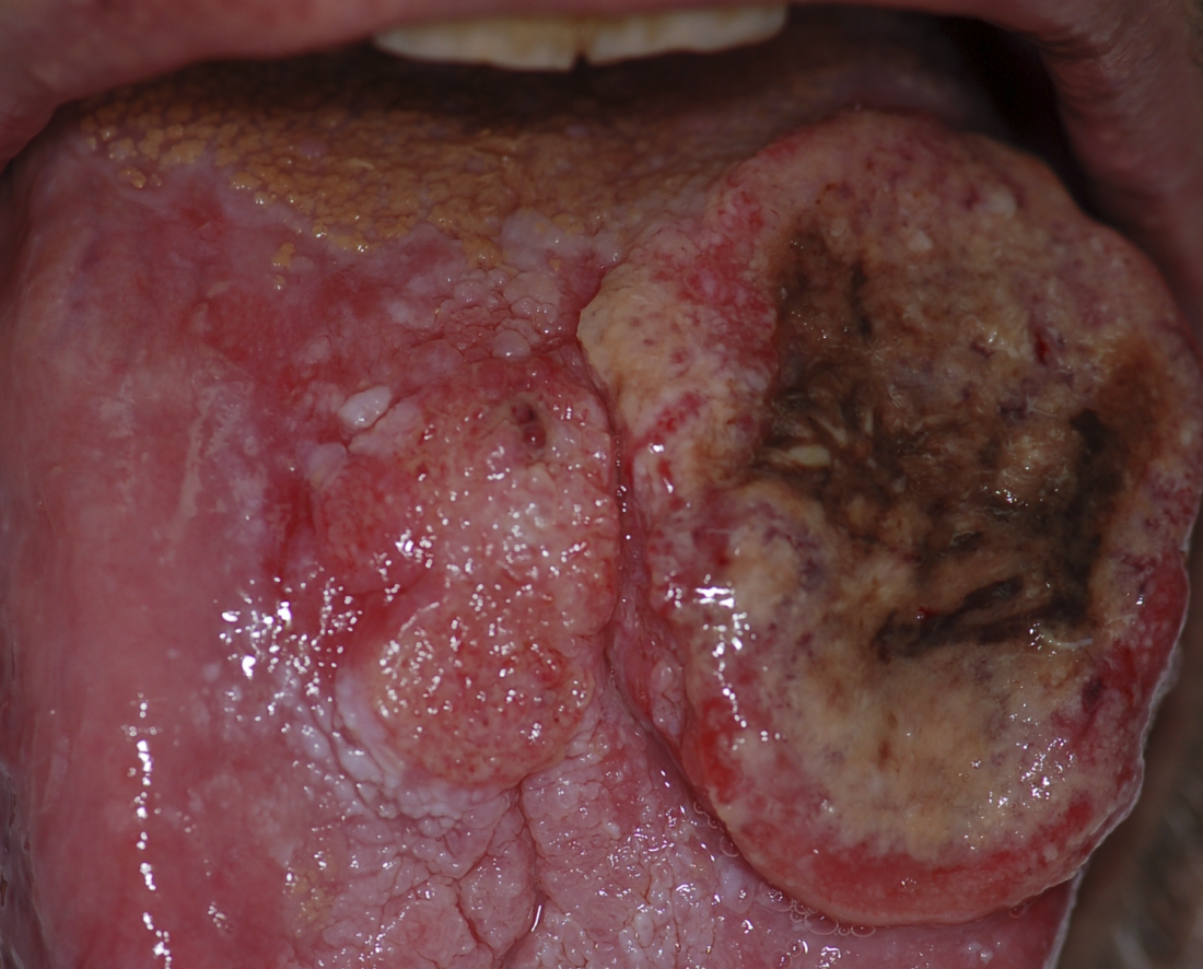 squamous cell carcinoma base of tongue