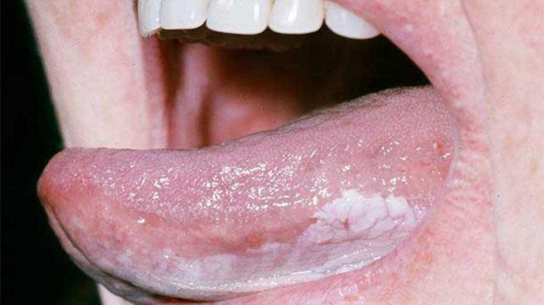 Tongue Cancer Symptoms Pictures And Outlook