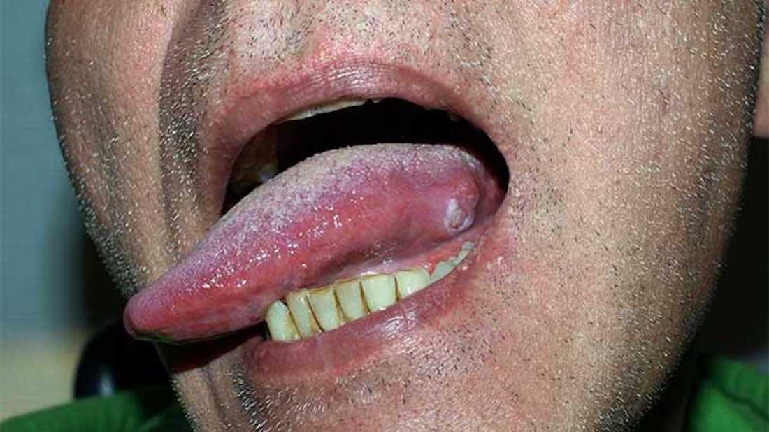 mouth-cancer-bumps-under-tongue