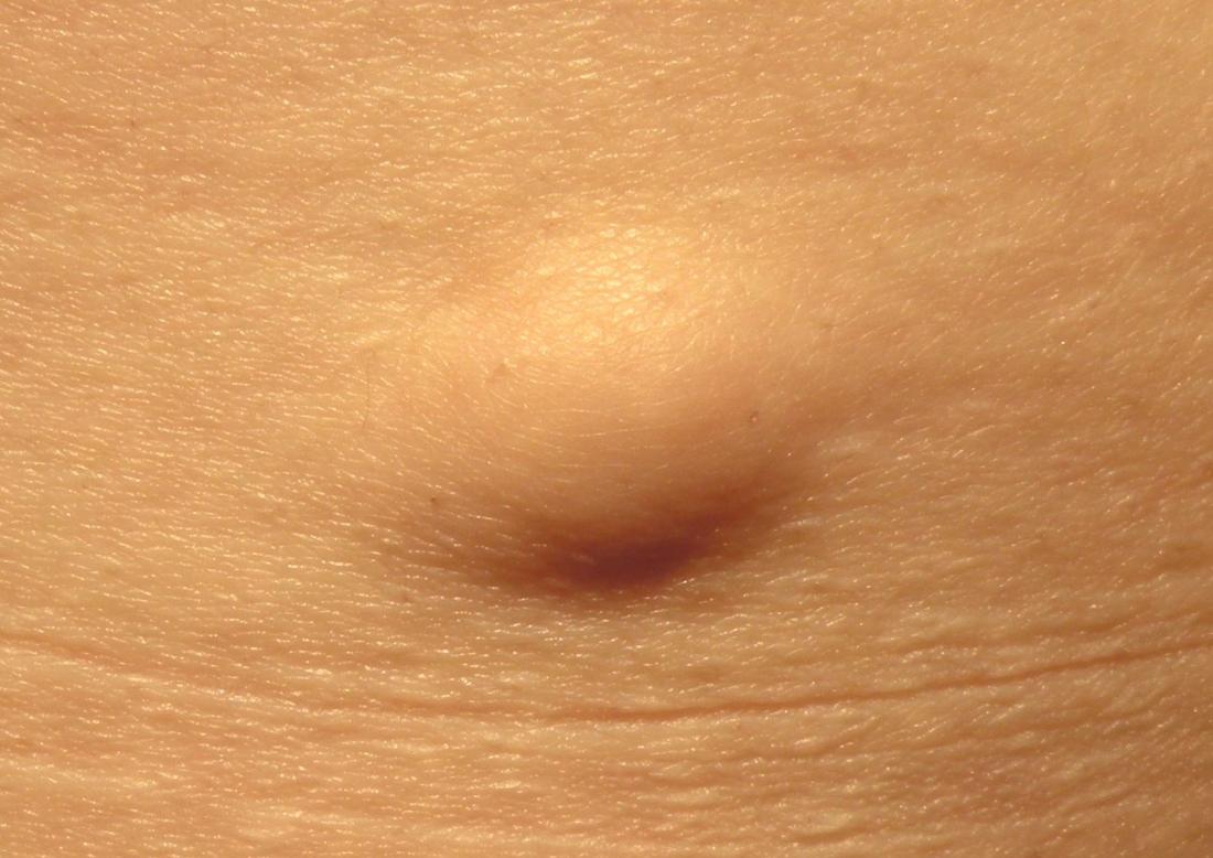 Lipoma: Causes, symptoms, diagnosis, and removal