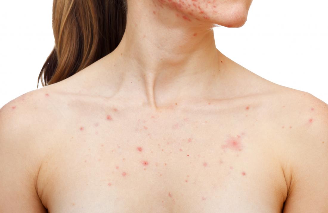 female chest acne