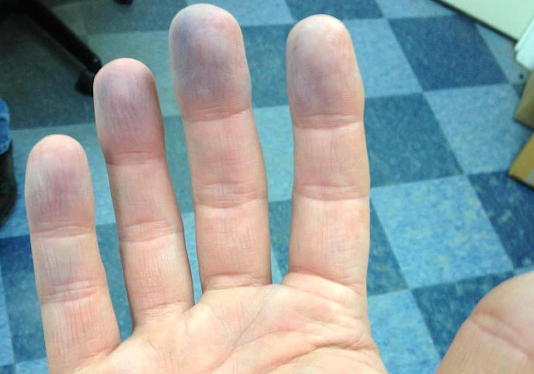 Peripheral cyanosis: Symptoms, diagnosis, and