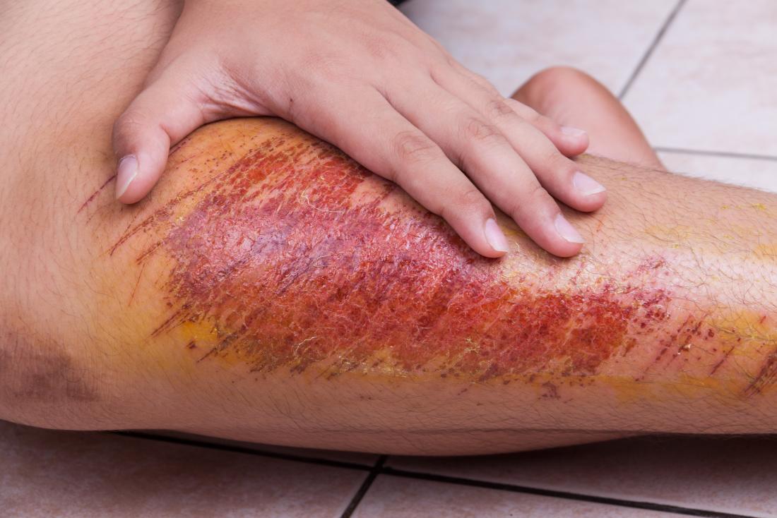 How To Get Rid Of Rug Burn