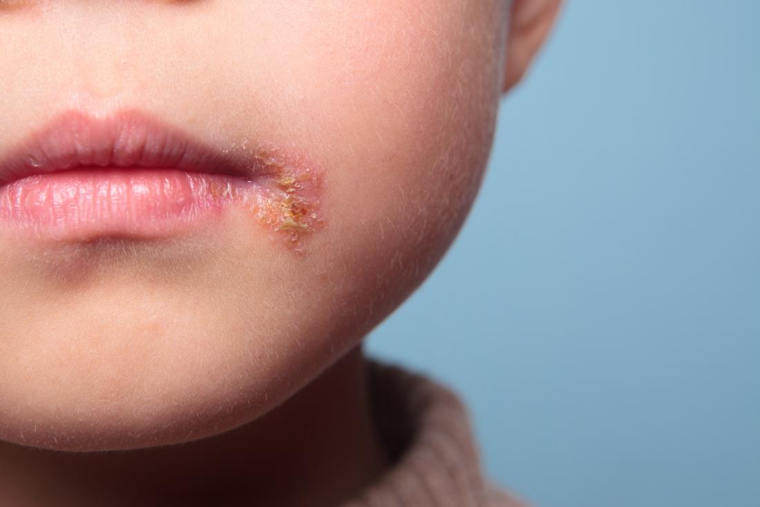 Can babies get cold sores? Causes, treatment, and risks