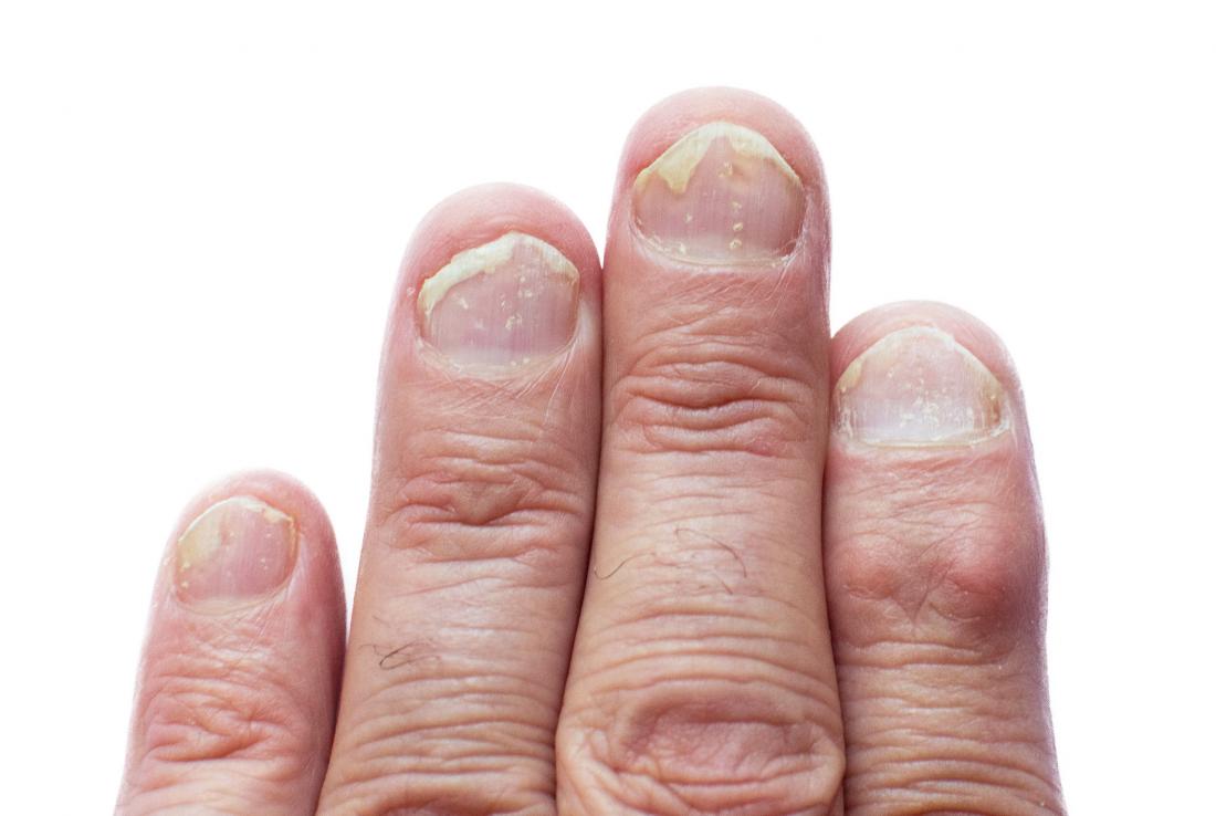 how-psoriatic-arthritis-affects-your-nails