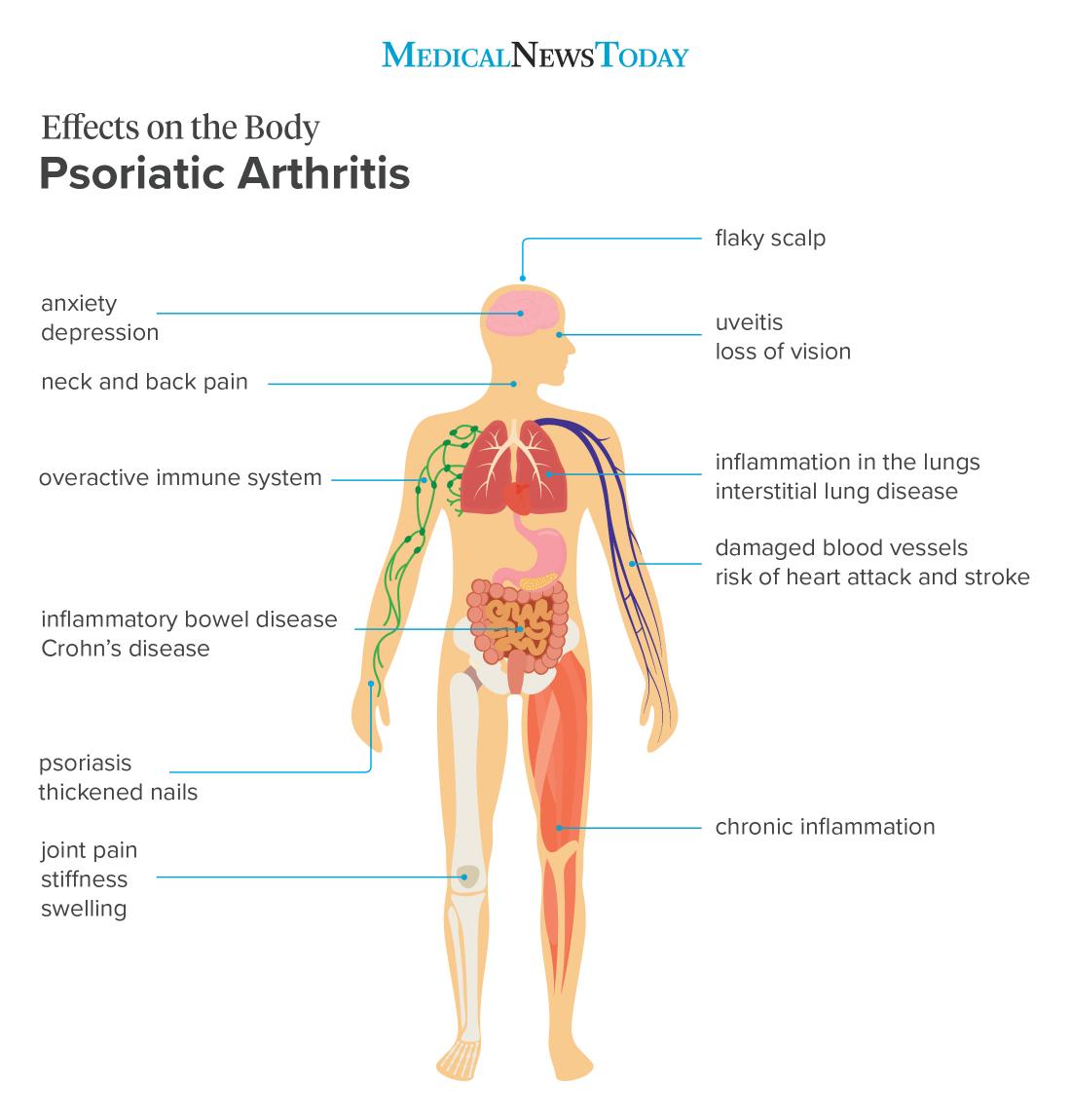 8 effects of psoriatic arthritis on the body