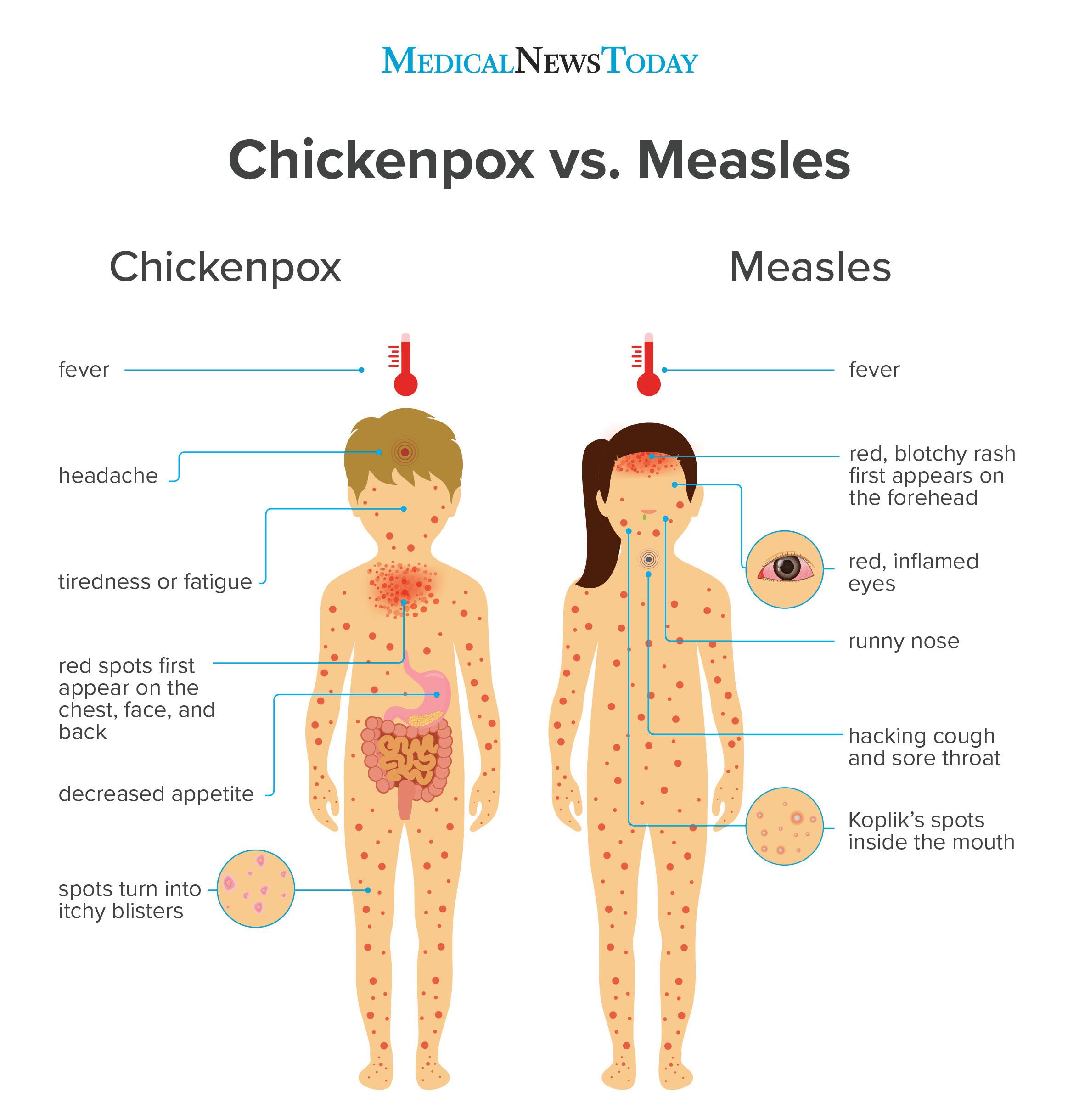 chickenpox vs measles infographic br image credit stephen kelly 2018 br