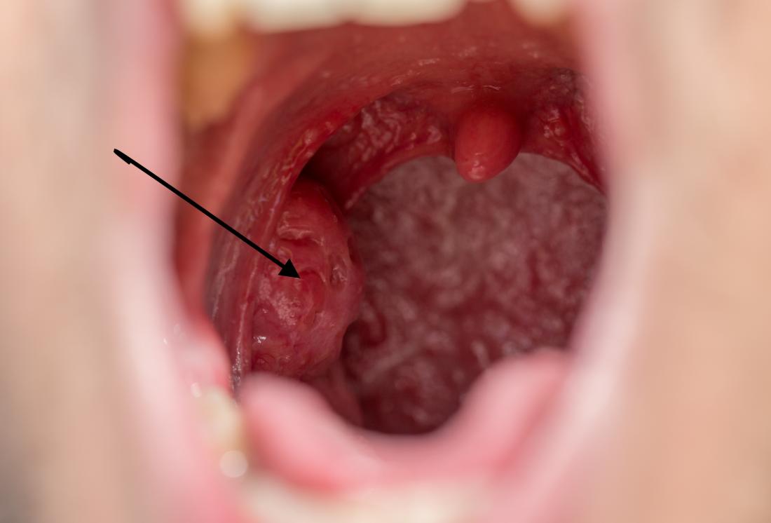 normal tonsils vs infected tonsils