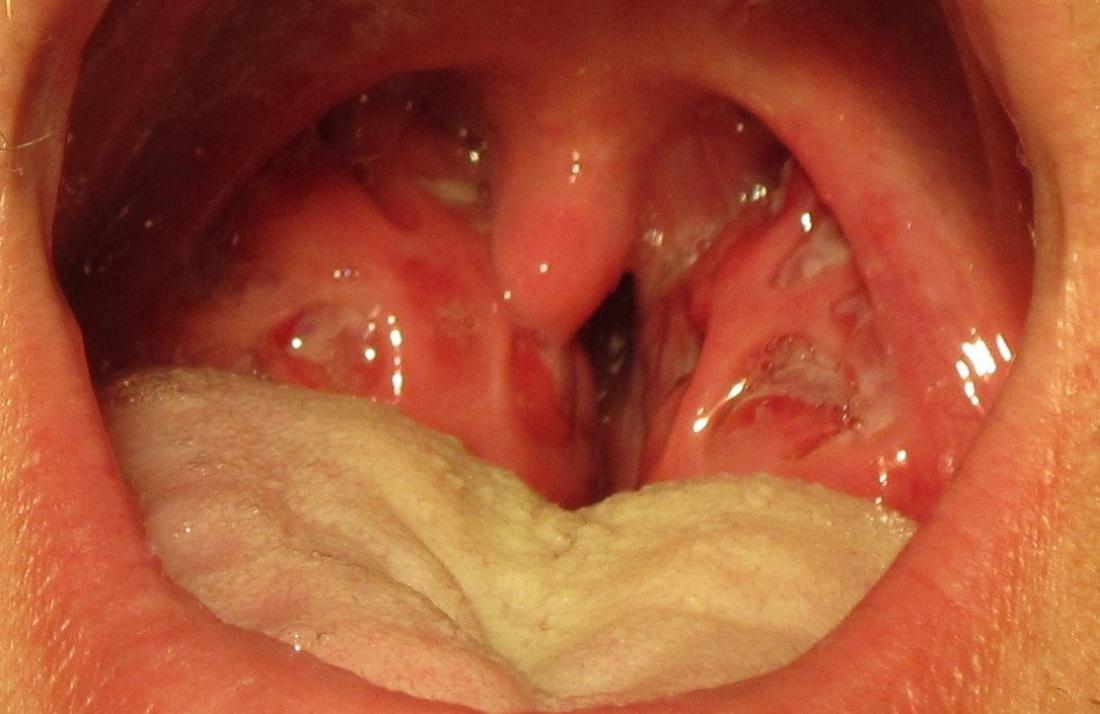 Holes in tonsils Causes symptoms and treatment