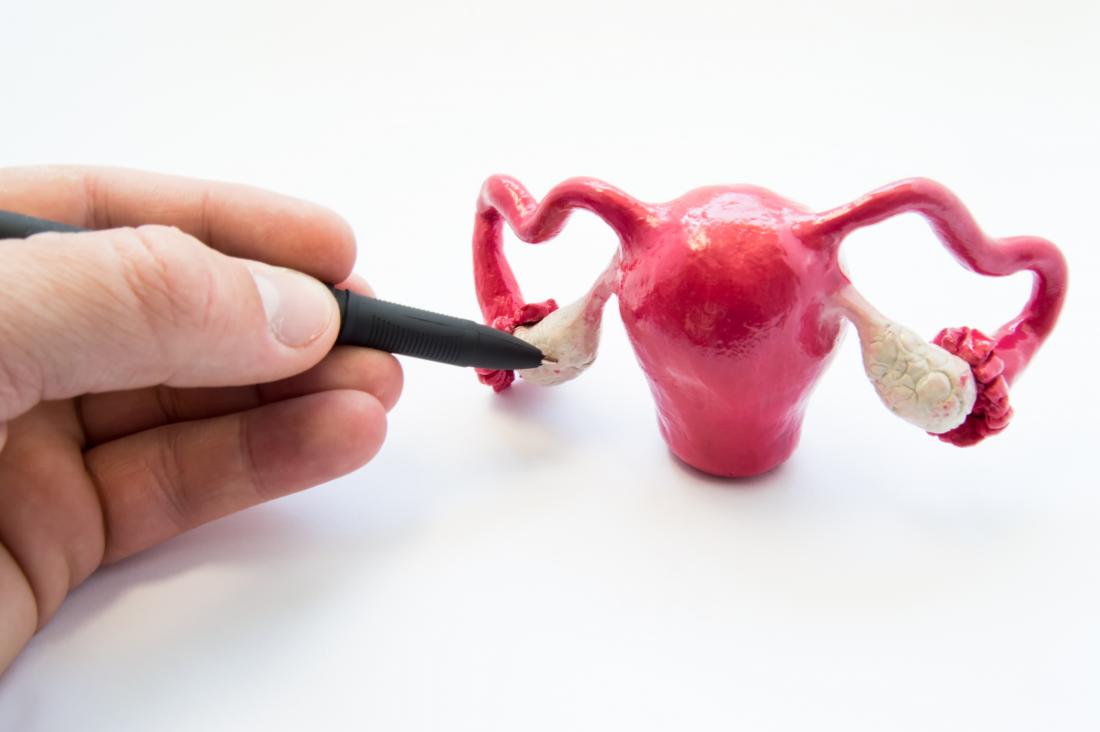 Ovarian torsion demonstrated by model of female reproductive system.
