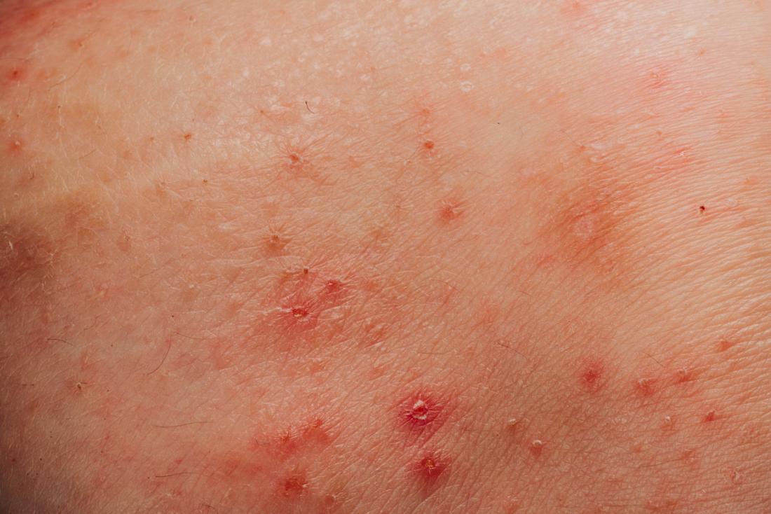 Genital Herpes Vs Pimples Whats The Difference