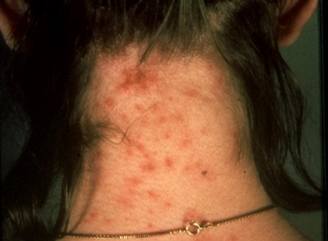 sea lice bites on humans