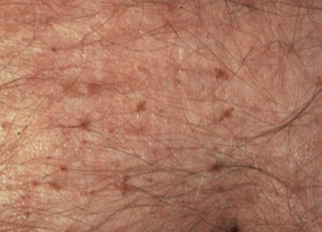 body lice rash