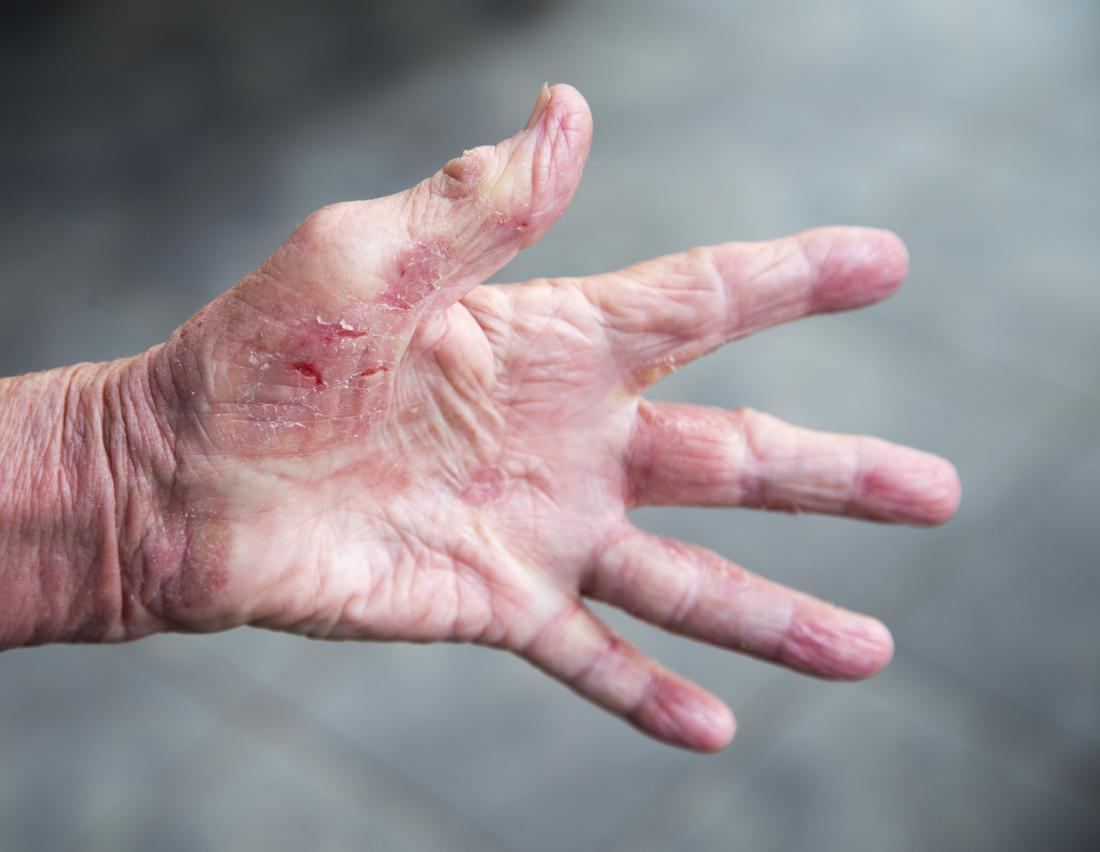 dermatitis on hands