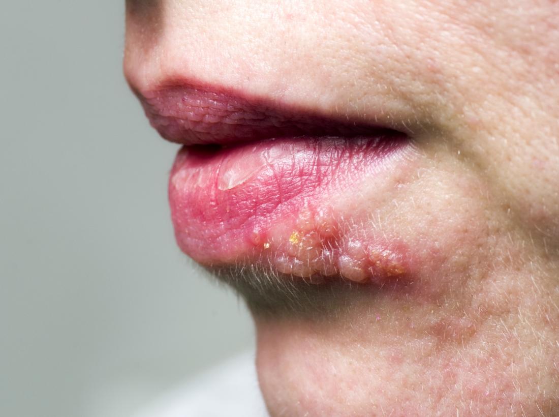 Shingles on the face Symptoms, treatment, and causes