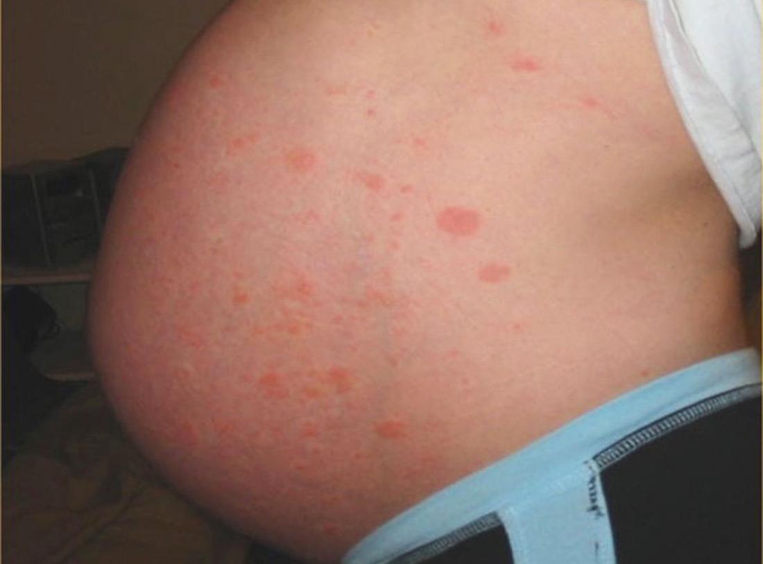 PUPPP rash in pregnancy: Natural treatments and prevention