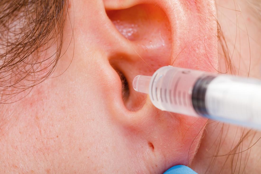 Removing earwax with hydrogen peroxide: Does it work, and how?