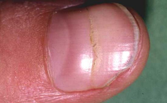 Beau's lines on nail